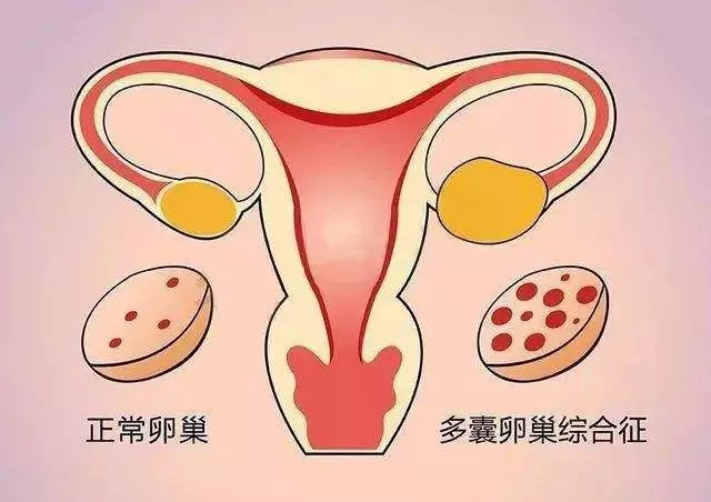 月经不调是多囊卵巢吗