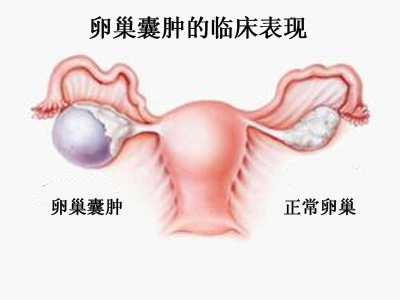 卵巢囊肿的临床表现
