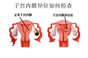 子宫内膜异位如何检查