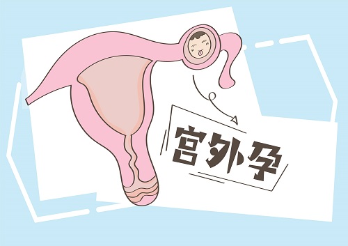 造成宫外孕的原因有哪些?